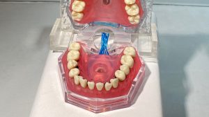 dental model open mouth alternate view